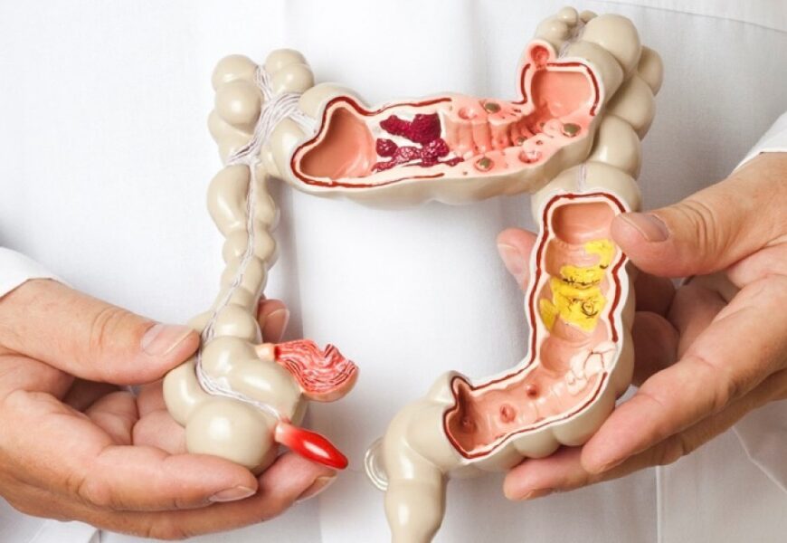 Câncer de intestino: Diagnóstico precoce e prevenção são fundamentais