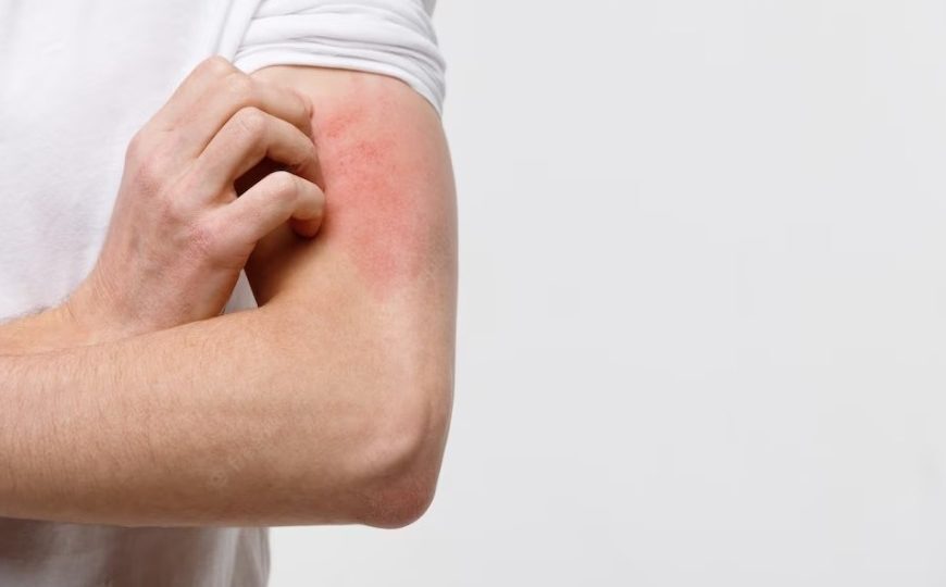 Dermatologista do Ipesaúde explica sobre combate e prevenção da hanseníase