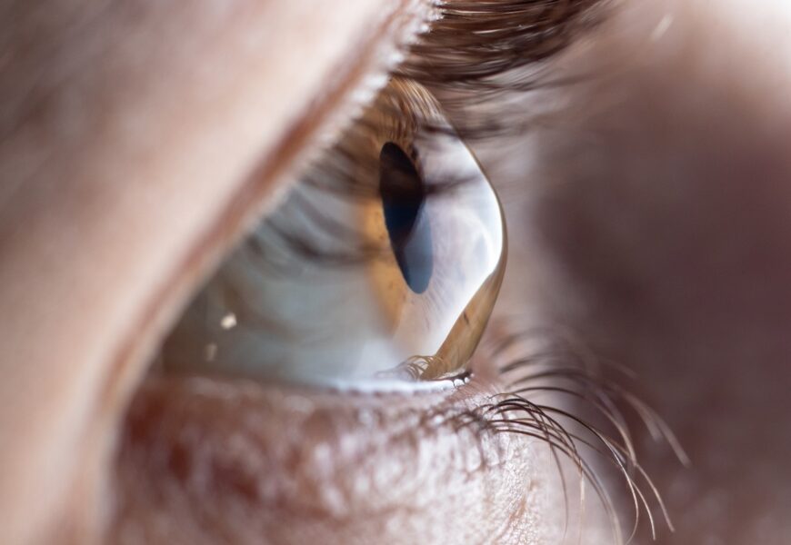Junho Violeta: oftalmologista alerta sobre o ceratocone e o hábito de coçar os olhos Junho Violeta: oftalmologista alerta sobre o ceratocone e o hábito de coçar os olhos